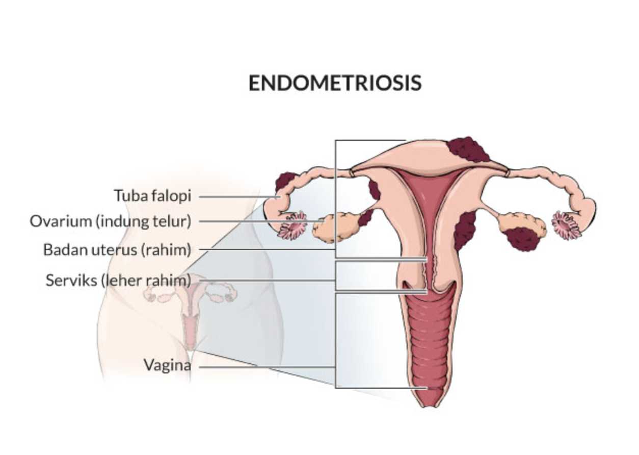 Endometriosis Mengintai Perempuan: Nyeri Haid Parah hingga Ancaman Infertilitas