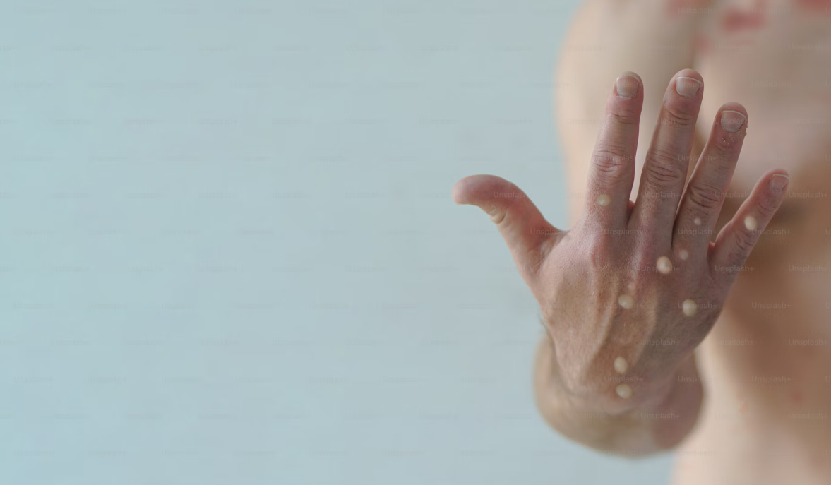 Cacar Monyet Kembali Menyebar Di Indonesia 2024, Begini Cara Mencegahnya!