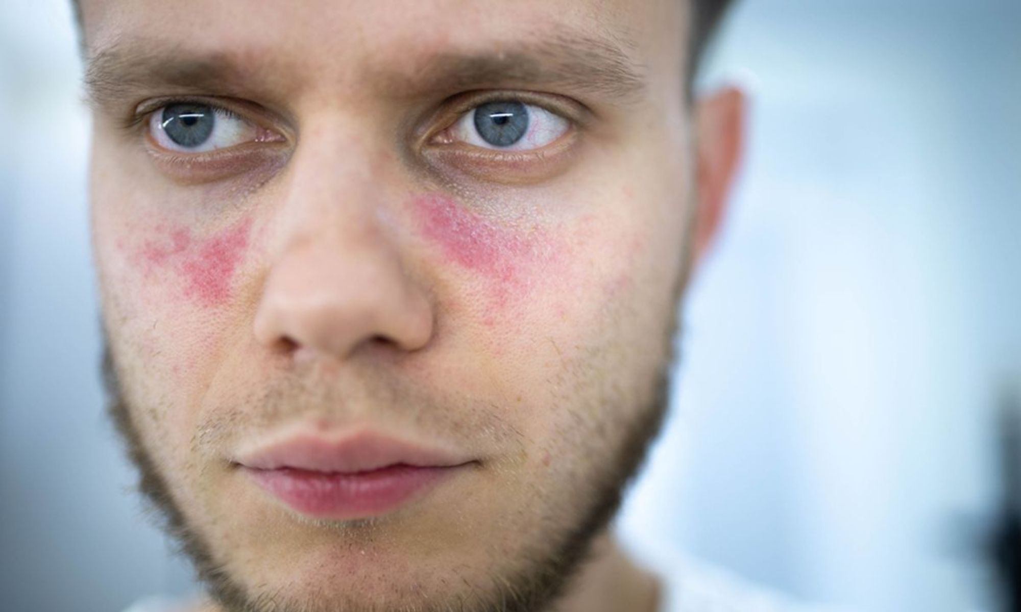 Lupus: Mengenal Penyakit Seribu Wajah yang Mengancam Kesehatan