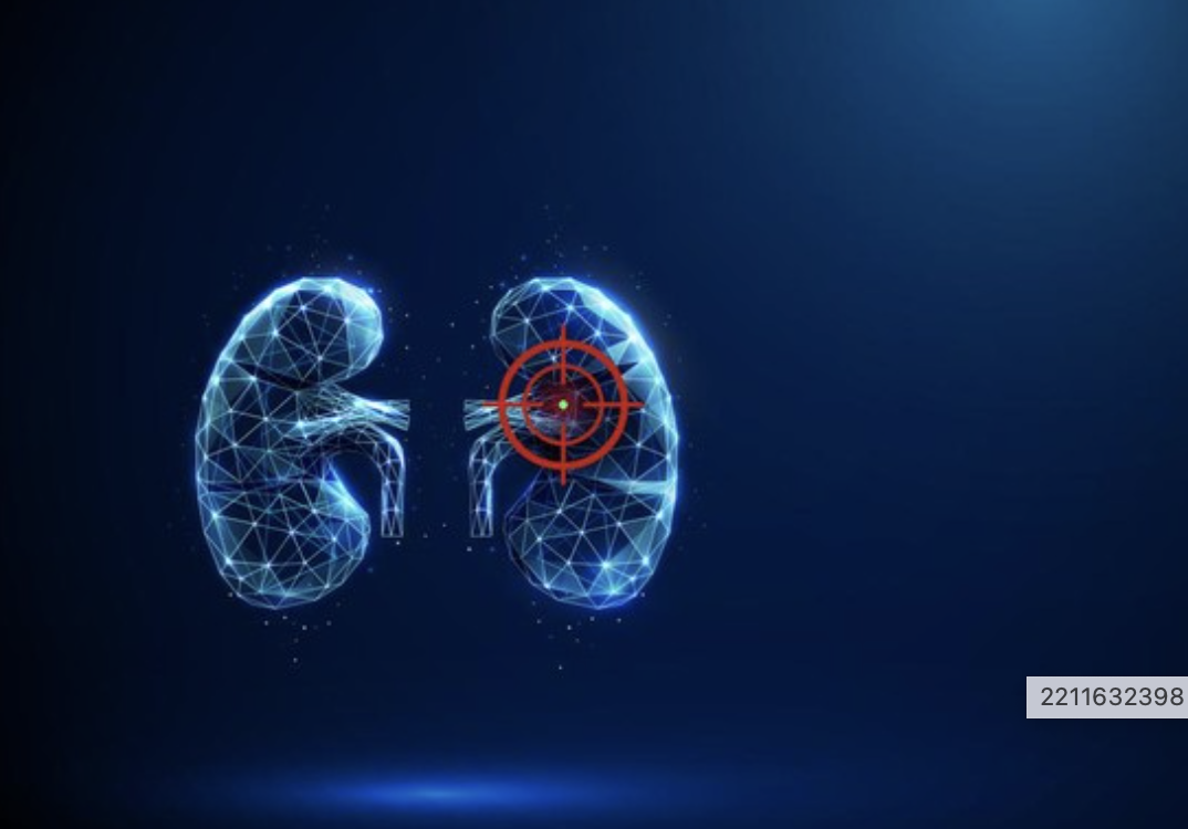 5 Makanan Penyebab Gagal Ginjal yang Harus Dibatasi Segera