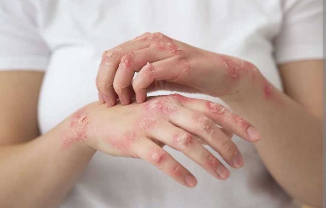 Benarkah Kusta Mudah Menular? Fakta Medis, Pencegahan, dan Cara Lindungi Diri