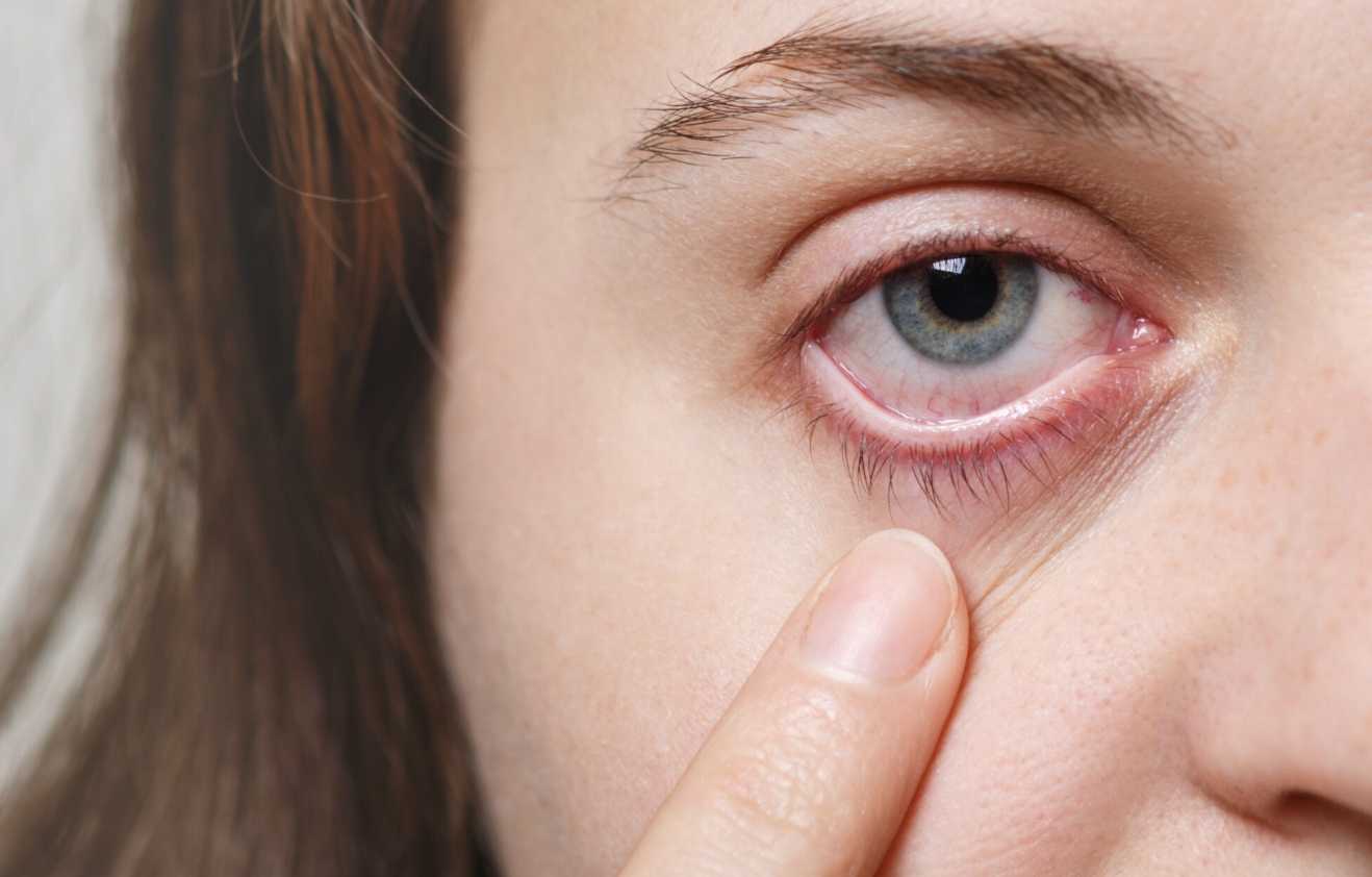 Tak Ada Unsur Kekerasan, Polisi Hentikan Kasus Siswi SD Palembang yang Alami Pertusis