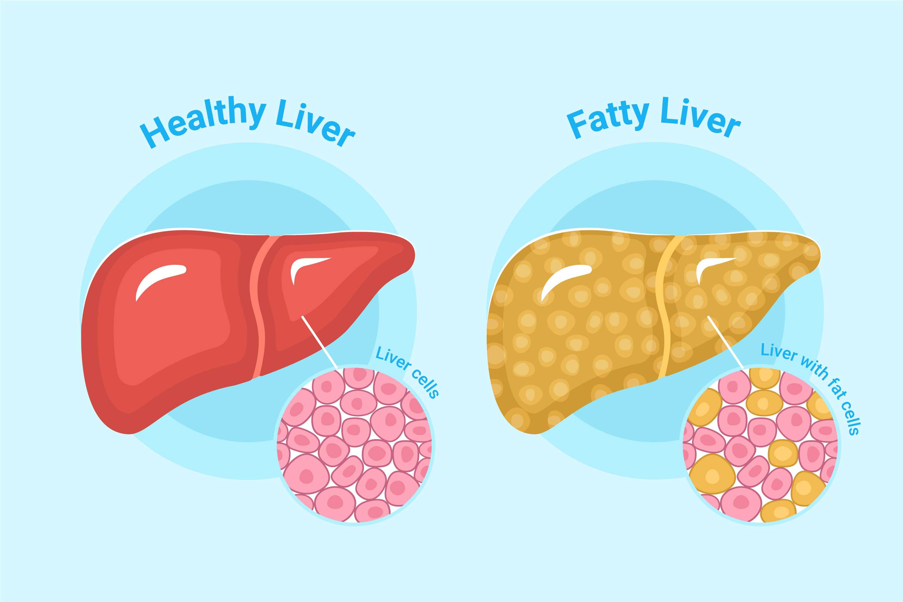 Gejala Fatty Liver yang Sering Tak Disadari, Peringatan Dini dari Dokter Harvard
