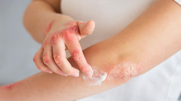 Psoriasis