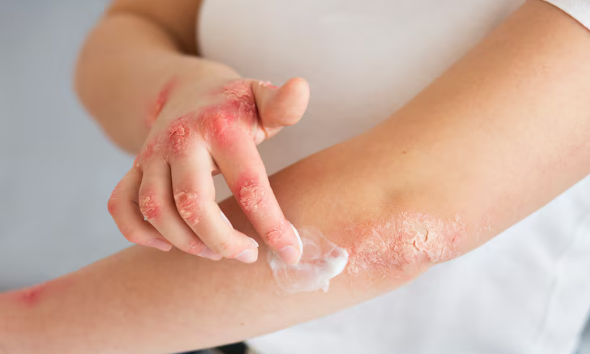 Psoriasis