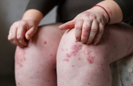 Psoriasis di lutut