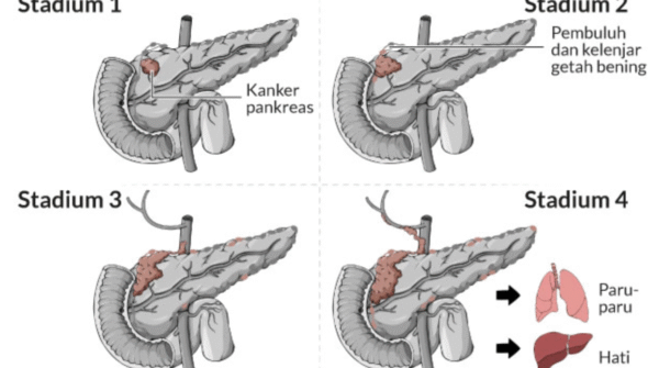 kanker pankreas