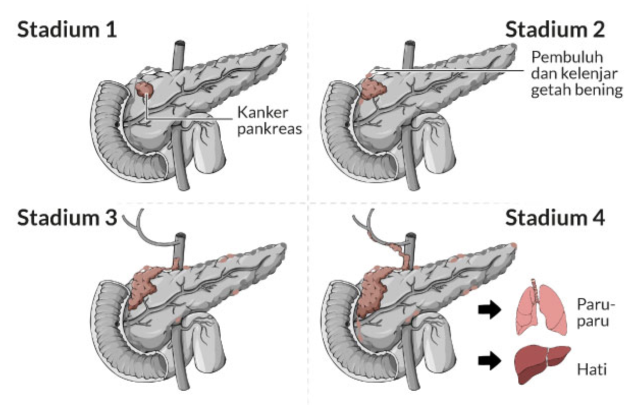 kanker pankreas