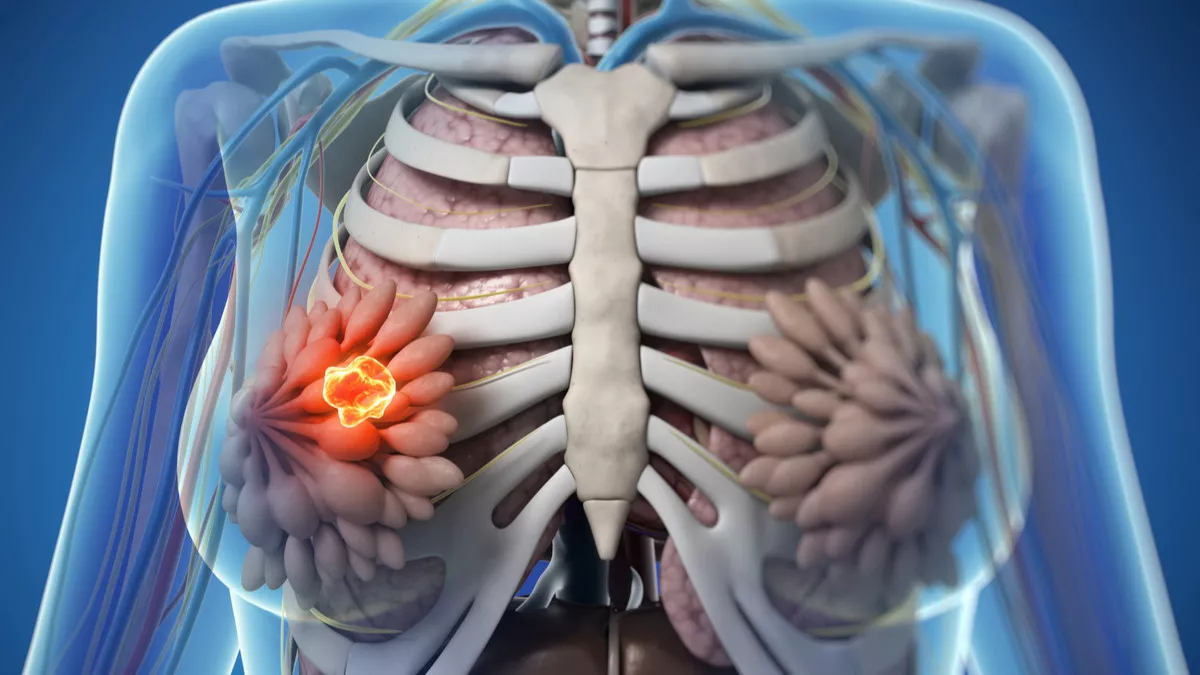 7 Penyebab Denial pada Kanker Payudara & Dampak Fatalnya bagi Pasien Indonesia