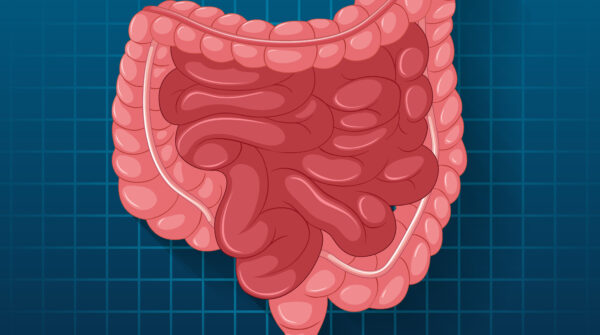 Dokter Harvard Terkejut, Kasus Kanker Kolorektal Usia Muda Naik 2% per Tahun